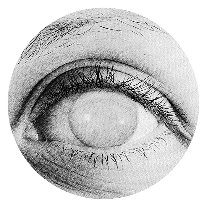 Cataracts