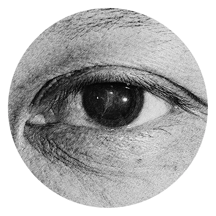 Diabetic Eye Diseases