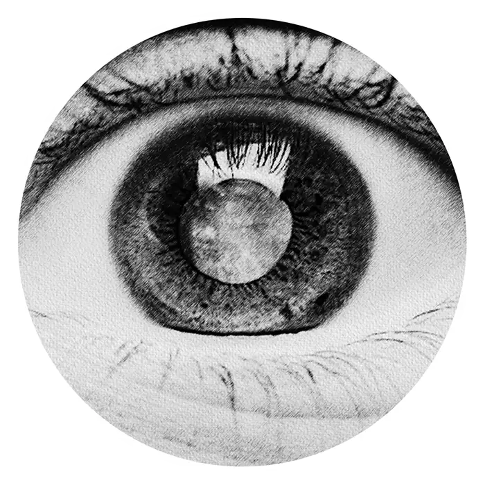 Glaucoma