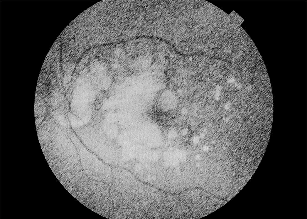 Age-related macular degeneration (AMD)