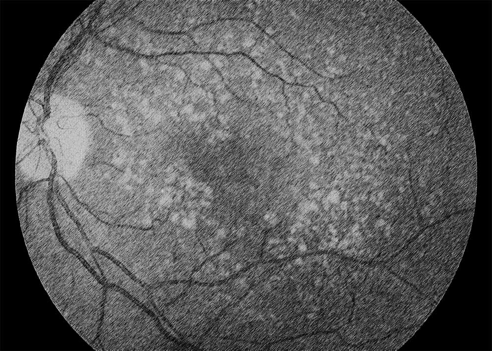 Agerelated macular degeneration (AMD) (2) Age-related macular degeneration (AMD)