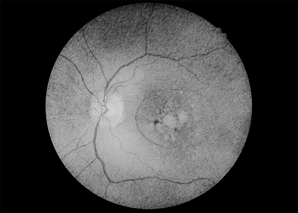 Agerelated macular degeneration (AMD) (3) Age-related macular degeneration (AMD)