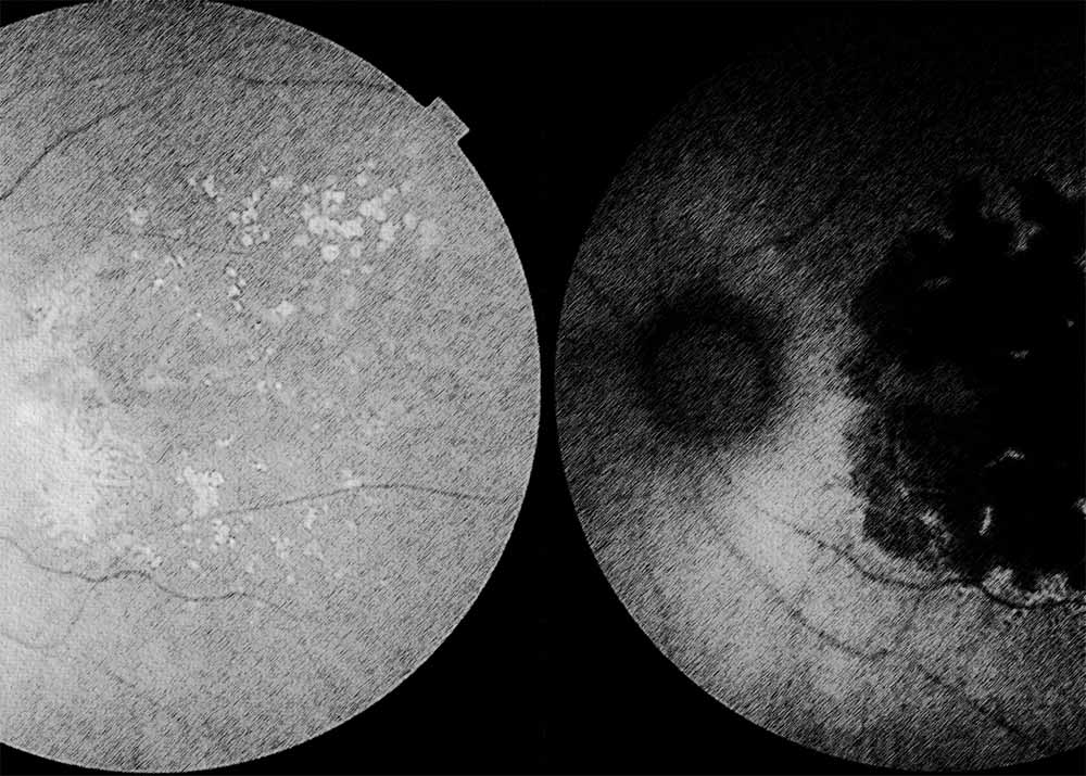 Agerelated macular degeneration (AMD) (4) Age-related macular degeneration (AMD)