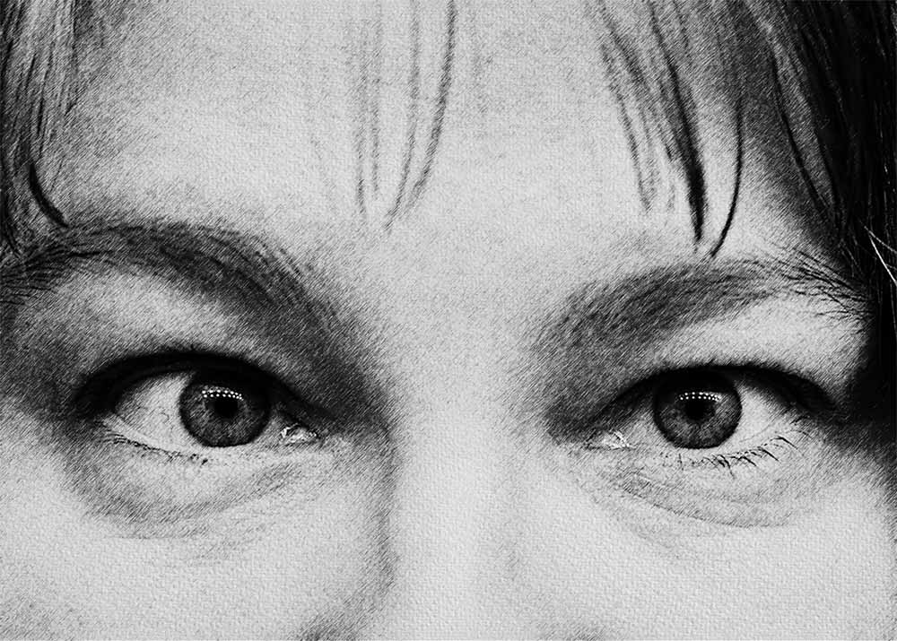 Amblyopia (Lazy Eye) (4) Amblyopia