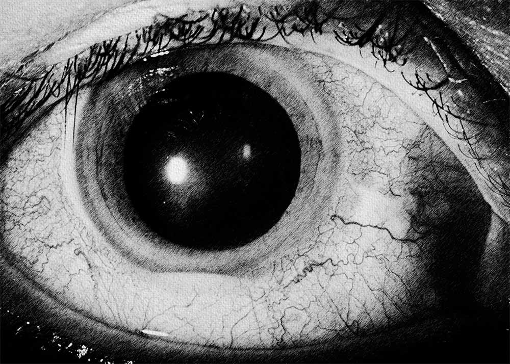 Behcet Disease (1) Behçet's Disease