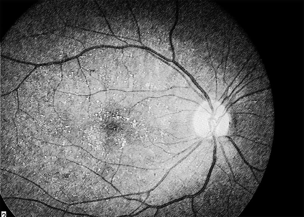 Biettis Crystalline Dystrophy