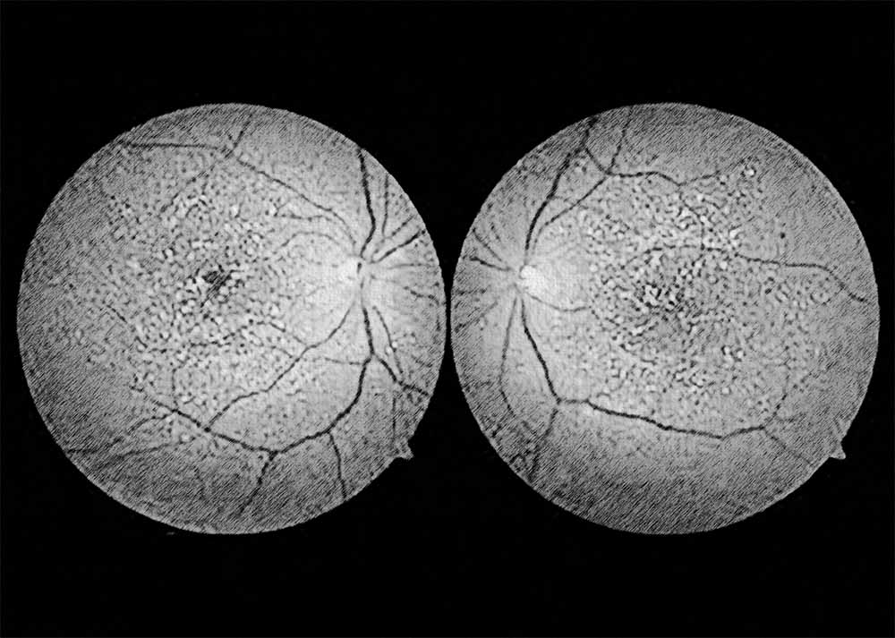 Biettis Crystalline Dystrophy