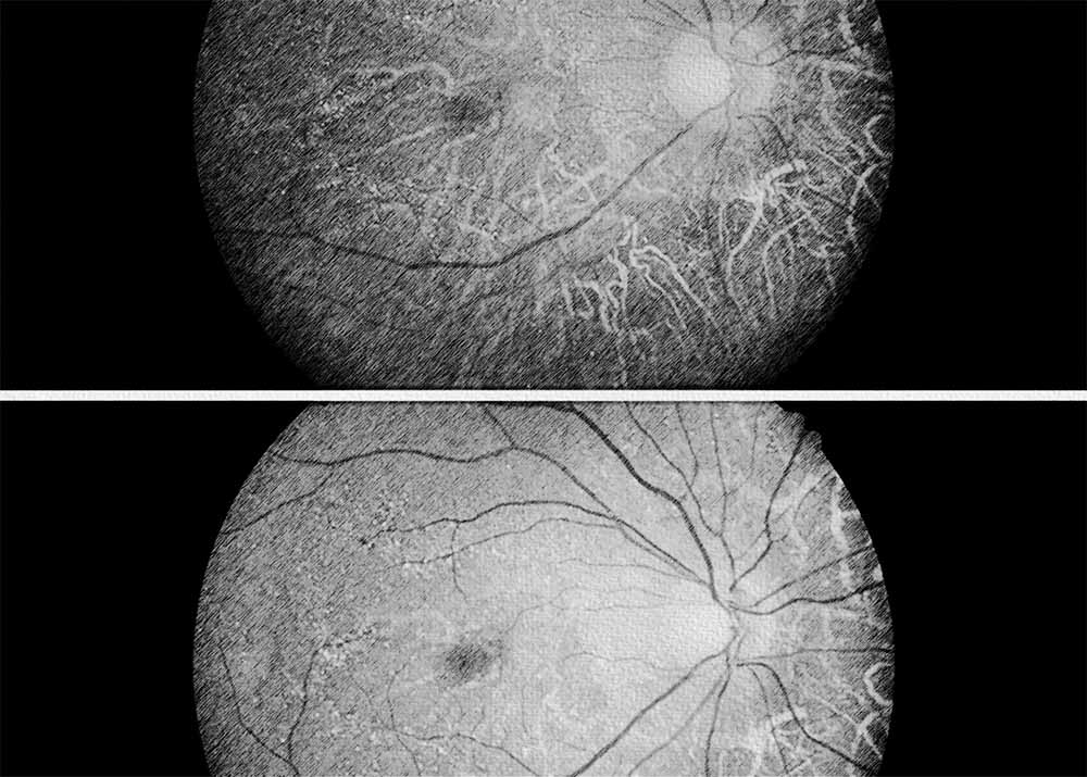 Biettis Crystalline Dystrophy