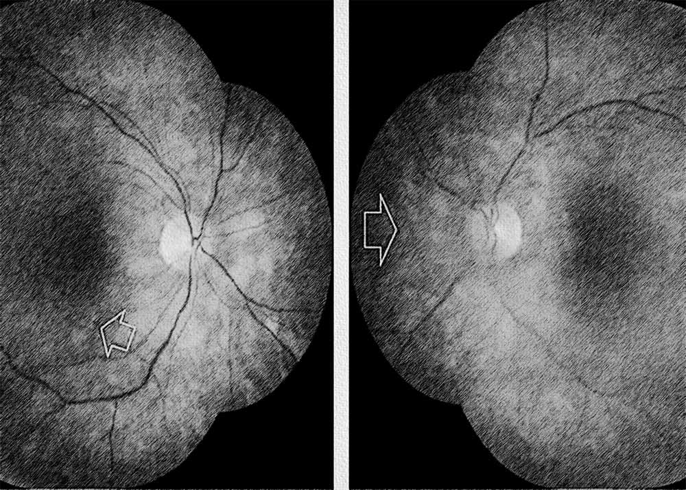 Birdshot Chorioretinopathy