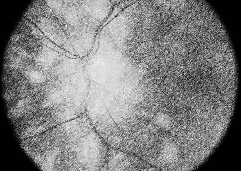 Birdshot Chorioretinopathy