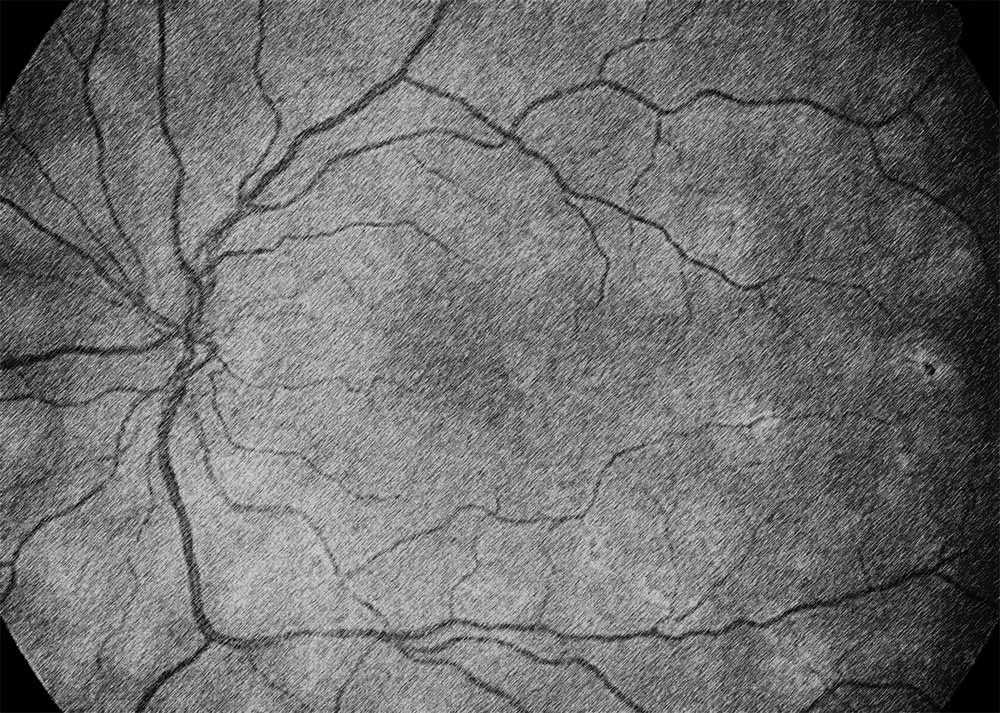 Birdshot Chorioretinopathy