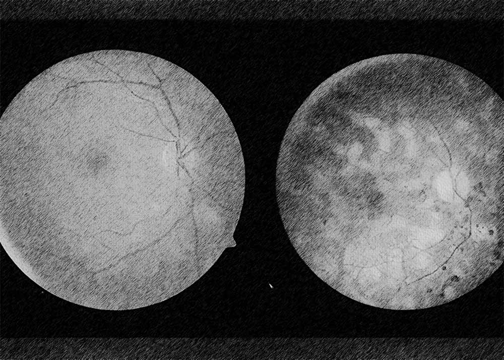 Birdshot Chorioretinopathy