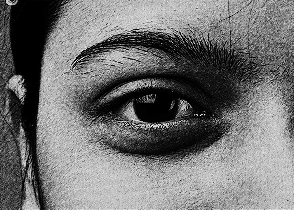 Blepharospasm (2) Blepharospasm
