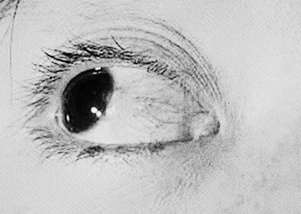 Bullous Keratopathy (2) Bullous Keratopathy