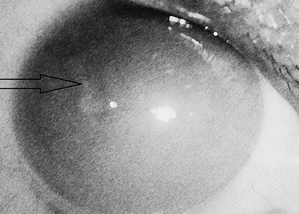 Bullous Keratopathy (4) Bullous Keratopathy