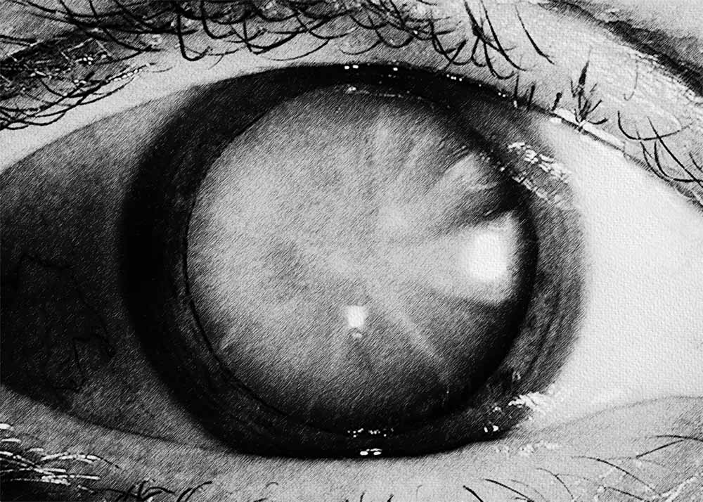 Cataracts (2) Cataracts