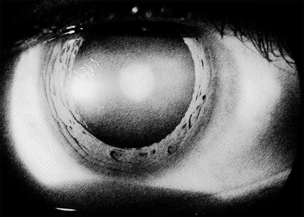 Cataracts (4) Cataracts