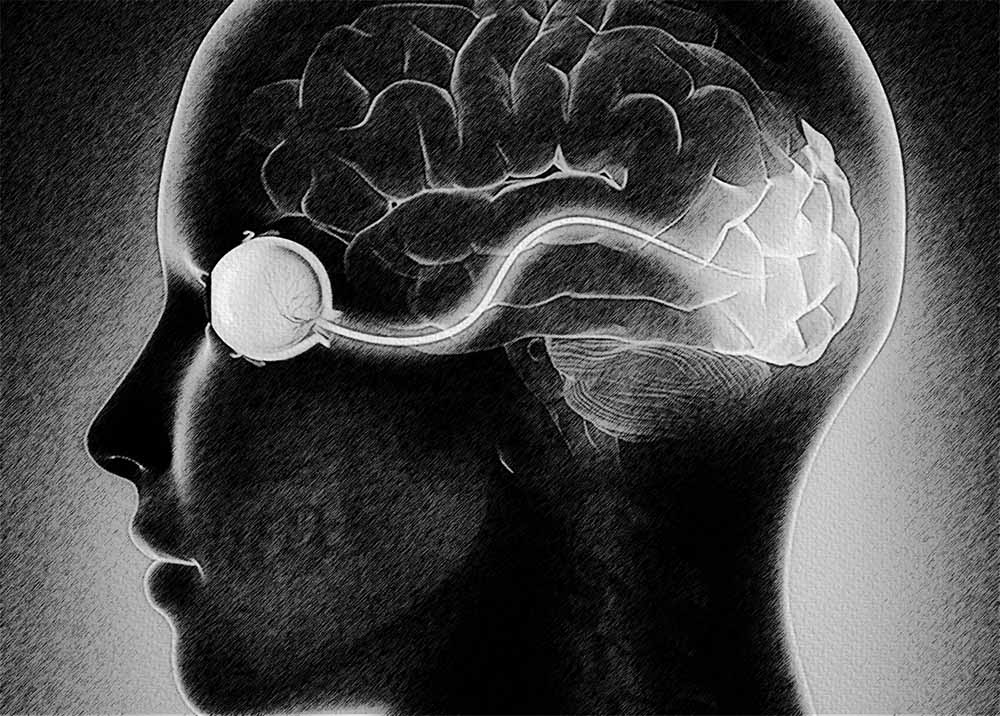 Cerebral Visual Impairment (CVI) (2) Cerebral Visual Impairment (CVI)