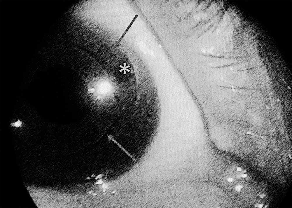 Closed-Angle Glaucoma