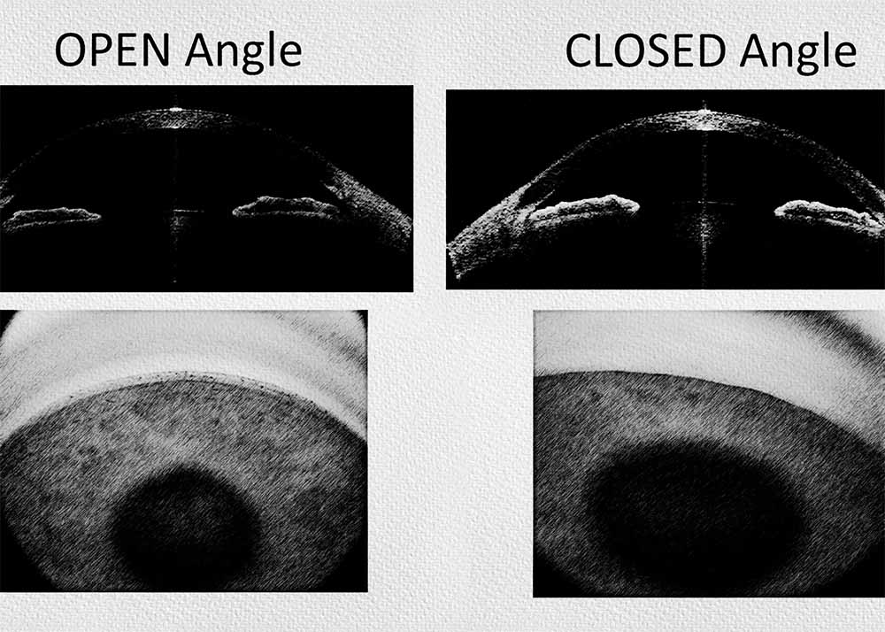 Closed-Angle Glaucoma