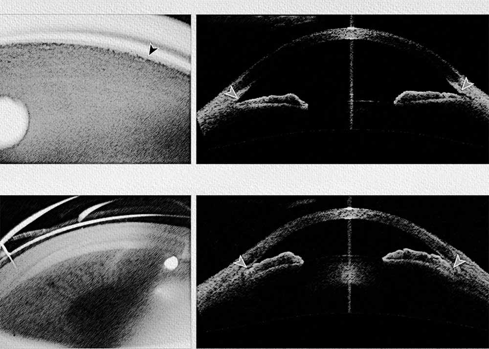 Closed-Angle Glaucoma