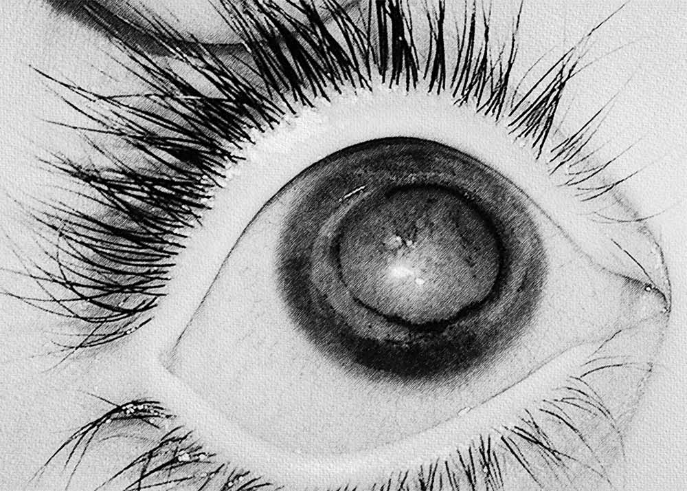 Coat Disease (1) Coat's disease