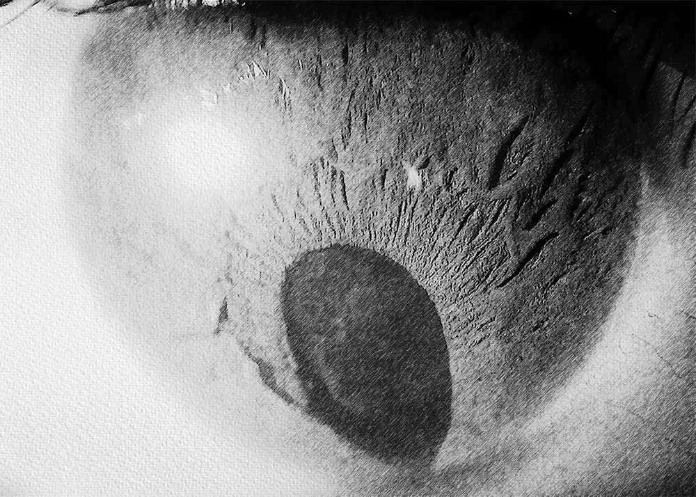 Coloboma