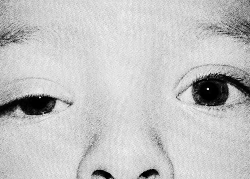 Congenital Ptosis