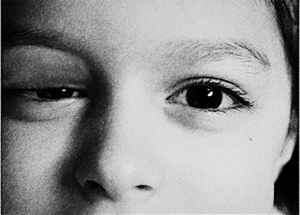 Congenital Ptosis