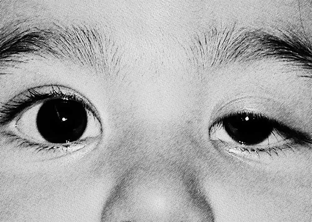 Congenital Ptosis