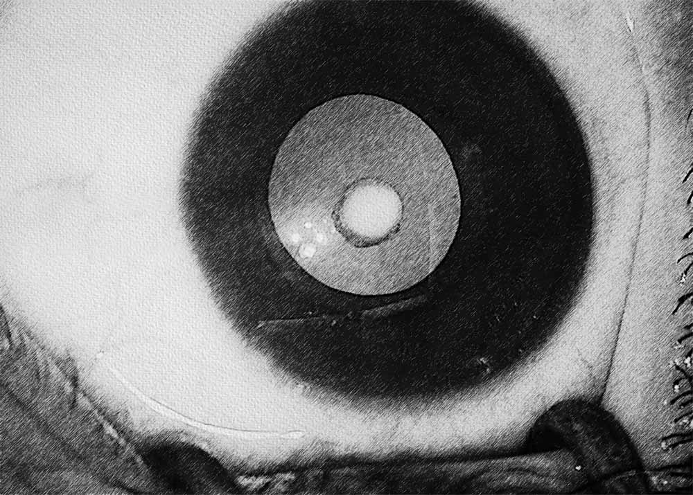 Congenital cataracts (2) Congenital cataracts