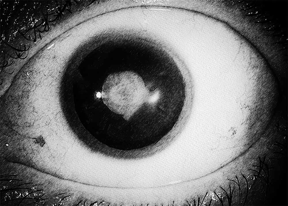 Congenital rubella cataract Congenital cataracts