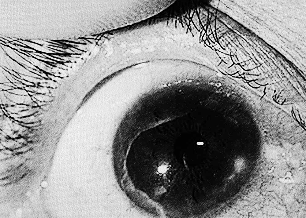 Corneal Abrasions