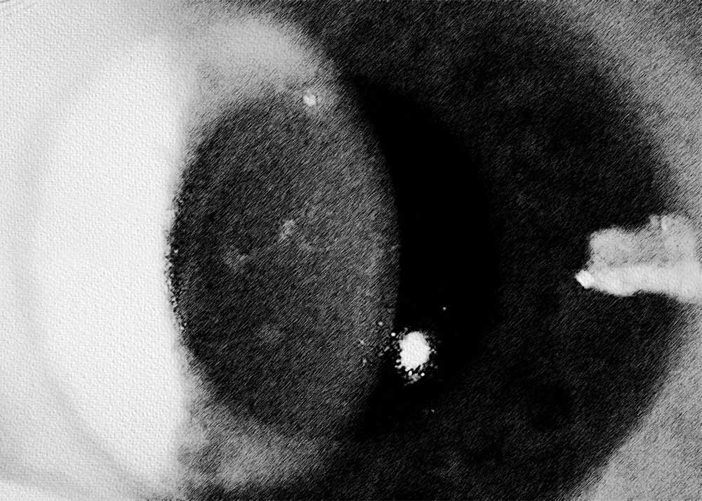 Corneal Dystrophy (1) Corneal Dystrophies