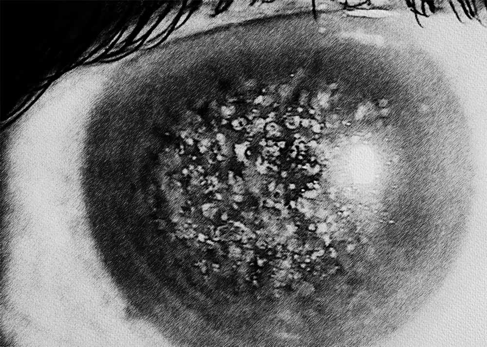 Corneal Dystrophy (4) Corneal Dystrophies