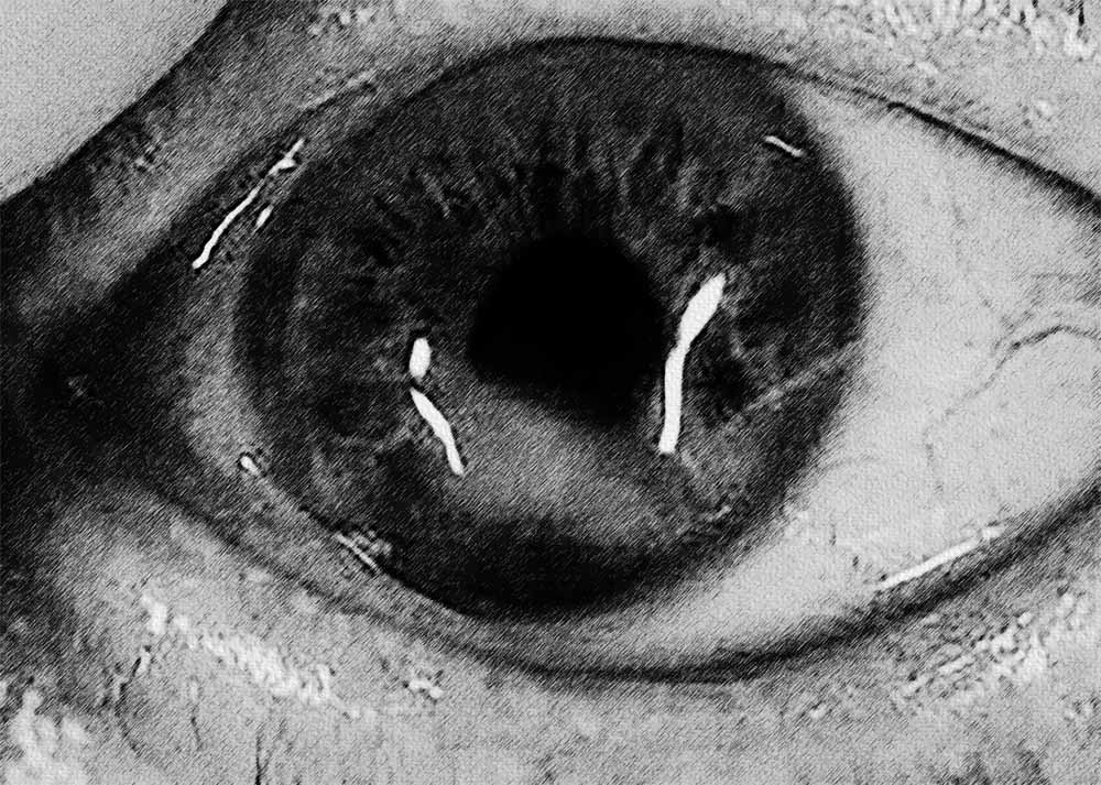 Corneal Ectasia