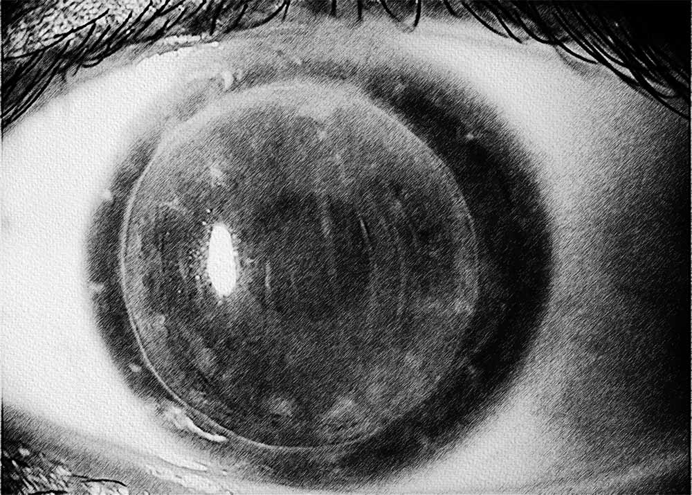 Corneal Transplant Rejection (1) Corneal Transplant Rejection