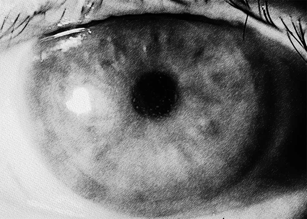 Corneal Transplant Rejection