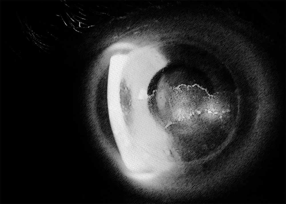 Corneal Transplant Rejection