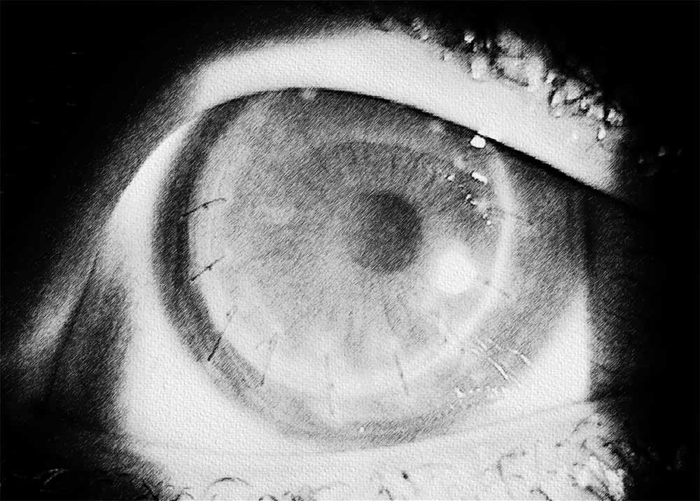 Corneal Transplant Rejection (4) Corneal Transplant Rejection