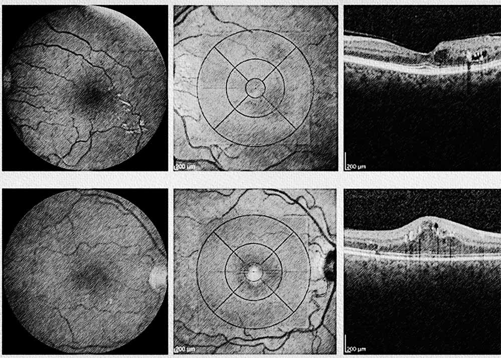 Diabetic Macular Edema (DME) (1) Diabetic macular edema (DME)