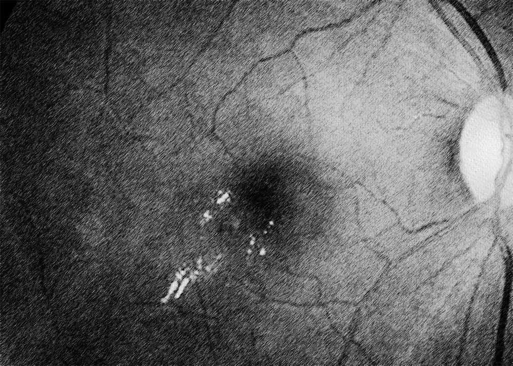 Diabetic Macular Edema (DME) (2) Diabetic macular edema (DME)