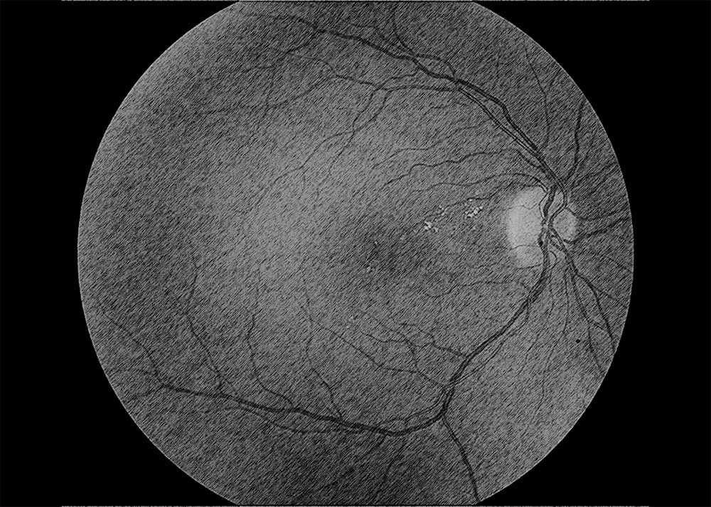 Diabetic Macular Edema (DME) (3) Diabetic macular edema (DME)