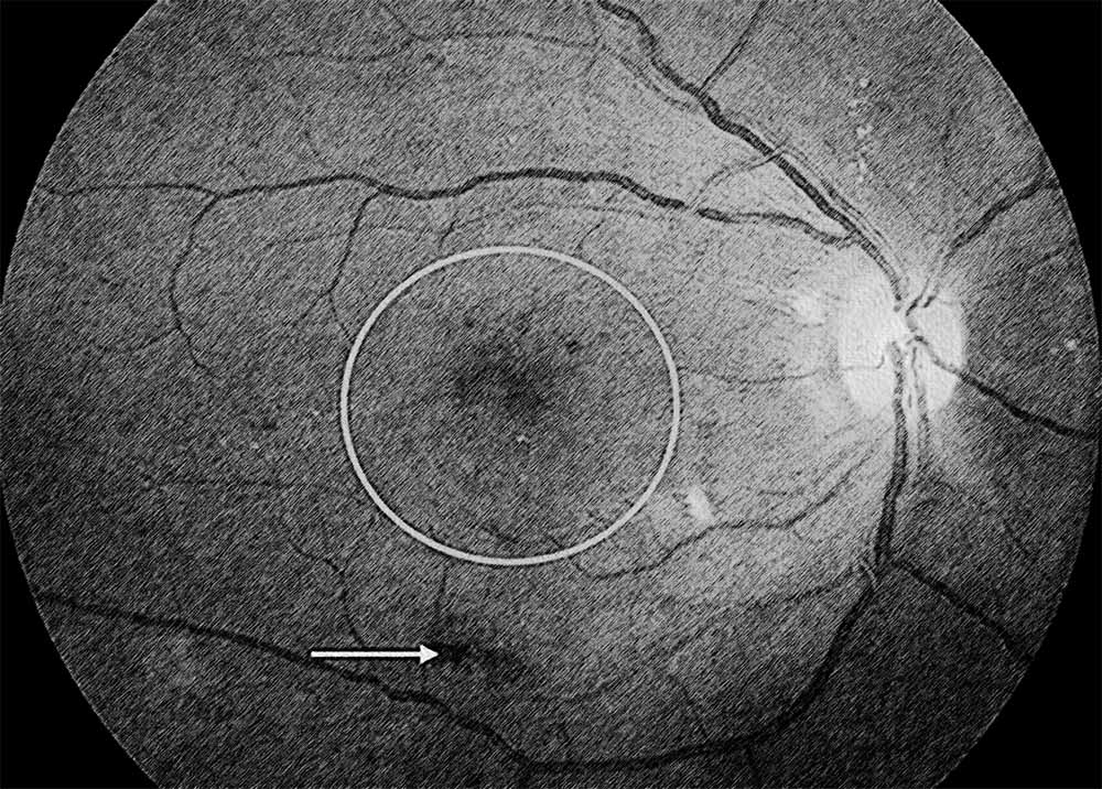 Diabetic macular edema (DME)