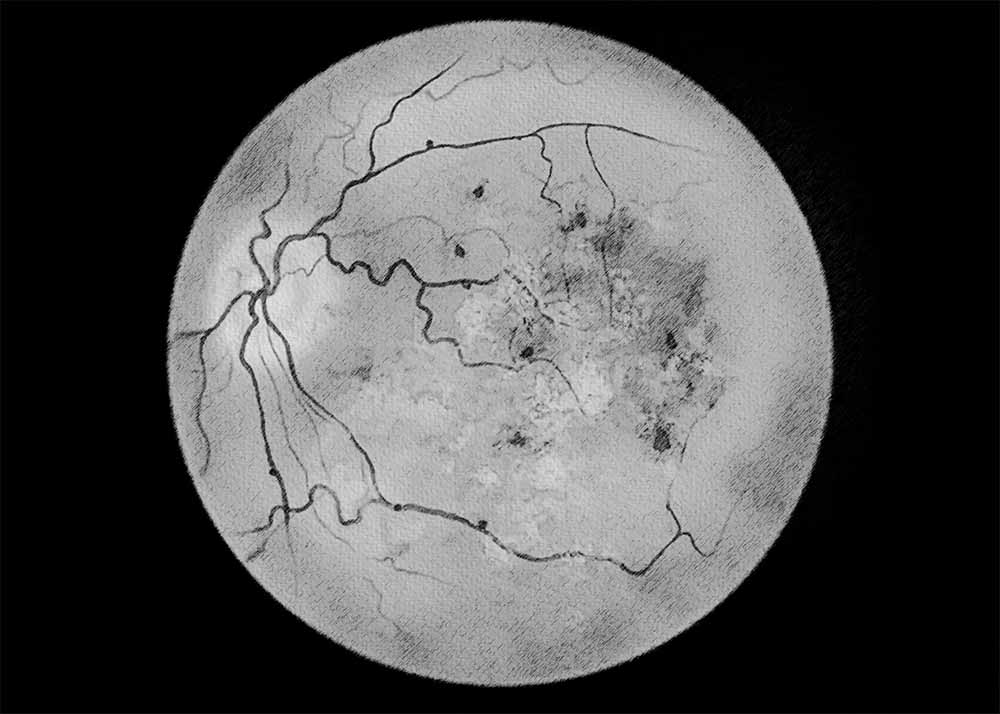 Diabetic retinopathy