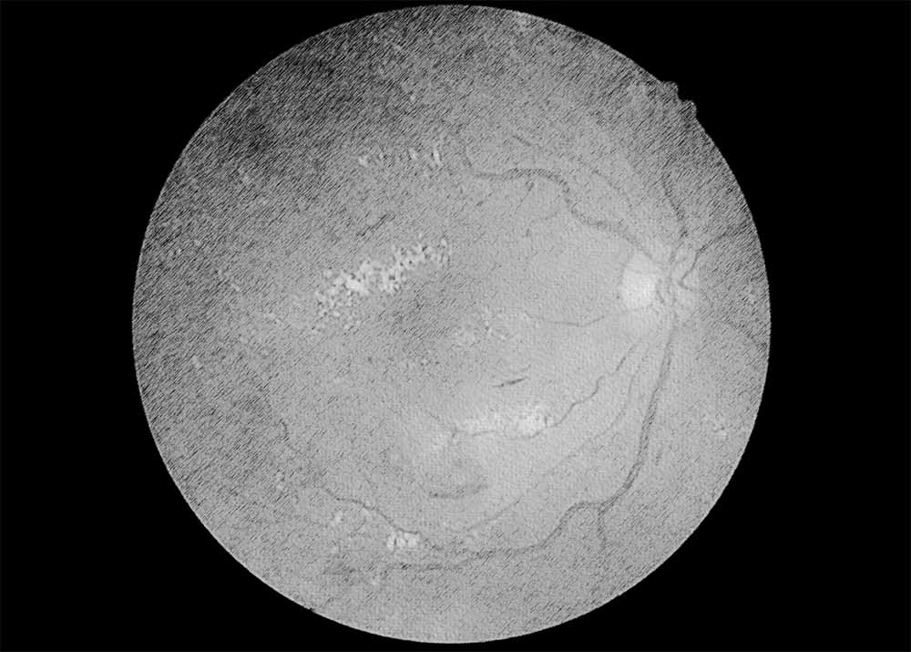 Diabetic retinopathy