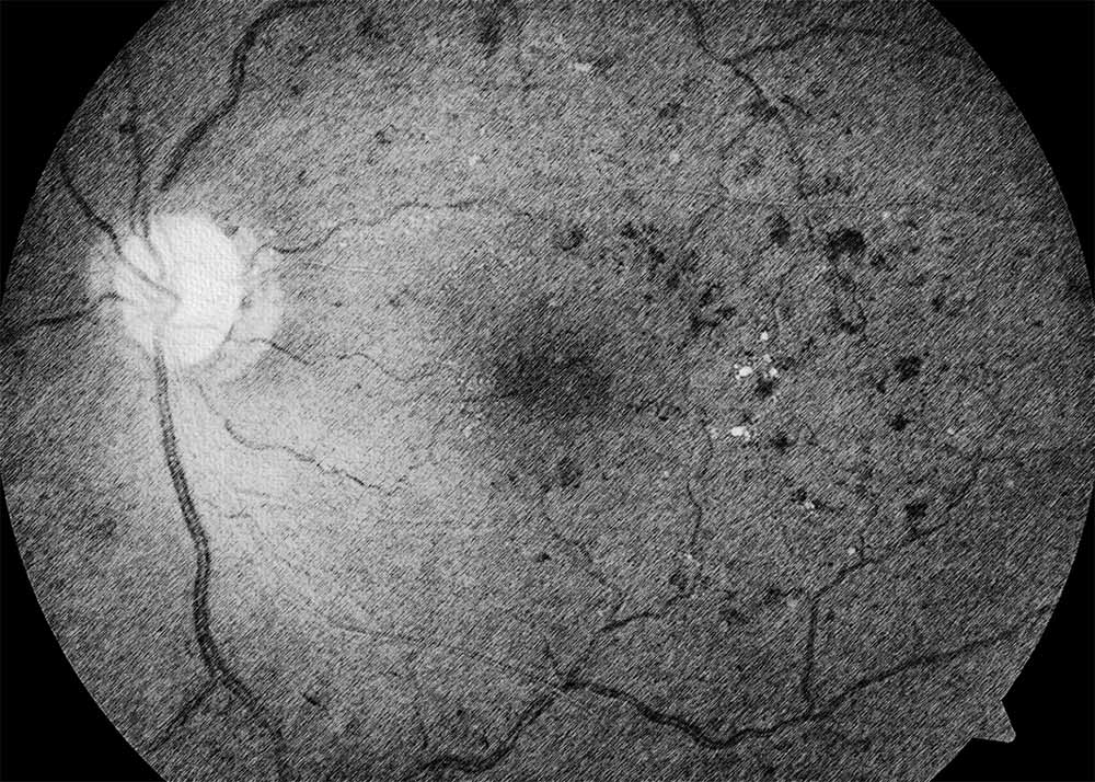 Diabetic retinopathy