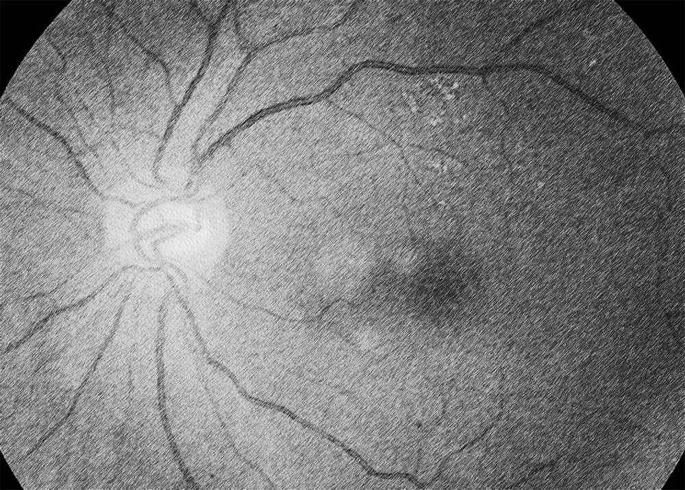 Diabetic retinopathy