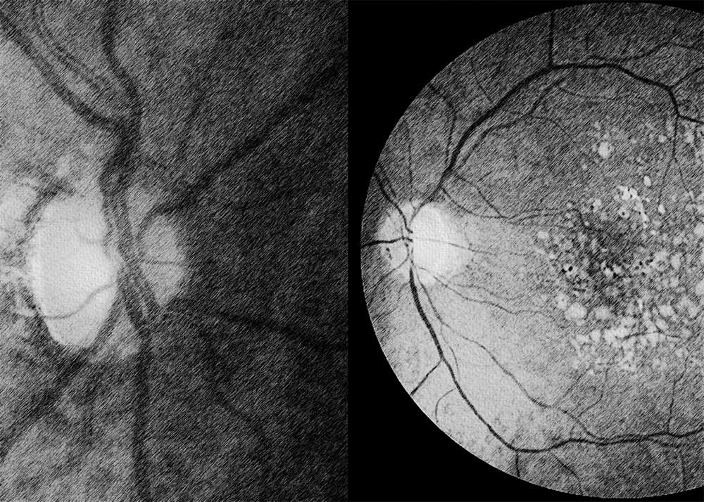 Diabetic glaucoma