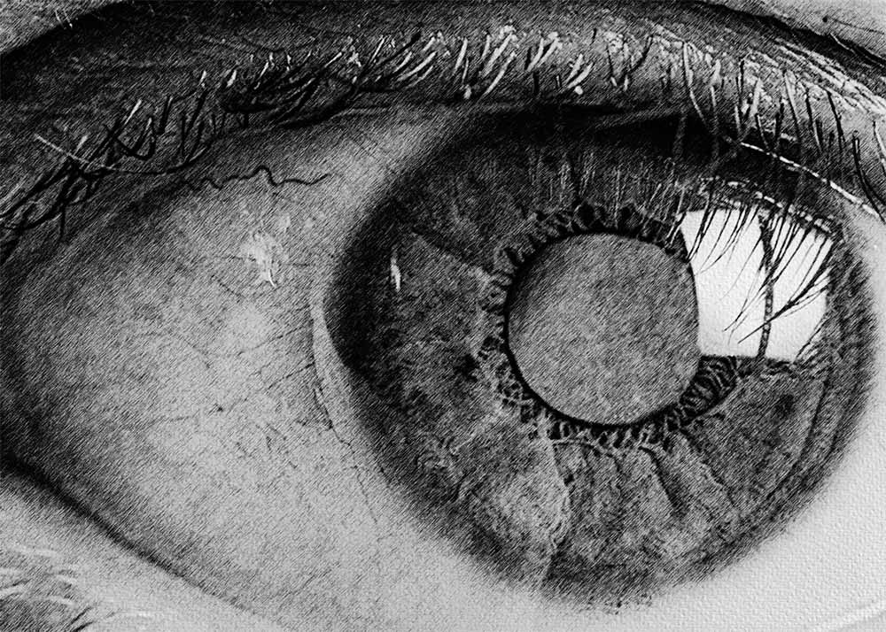 Diabetic glaucoma (1) Diabetic glaucoma
